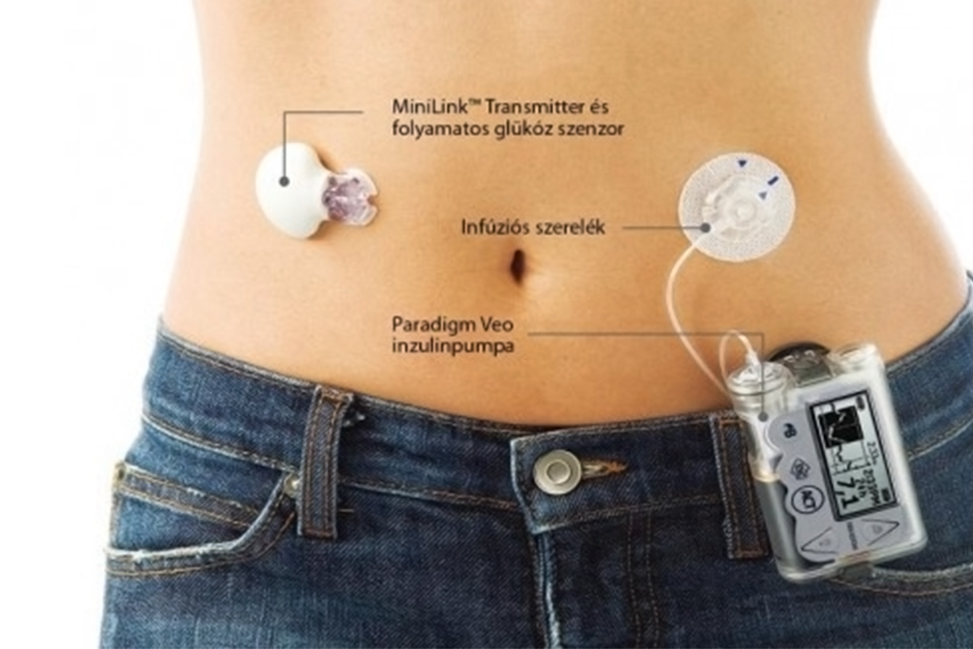 ____Eredeti-inzulinpumpa.jpg
